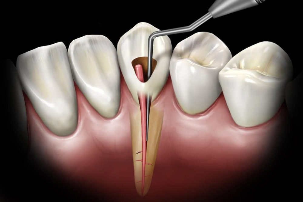 Parodontologie soins des gencives Aïn Chock Casablanca